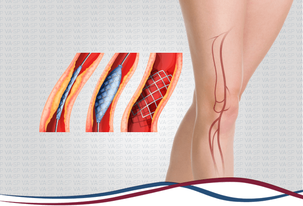vascularsp-tratamentos-endovasculares-angioplastia-arterias-perna-thumb