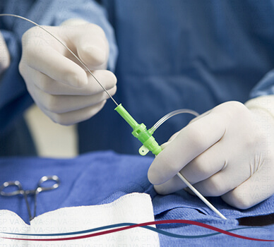 Imagem Cirurgia de Varizes (Laser Endovenoso) - Cateter