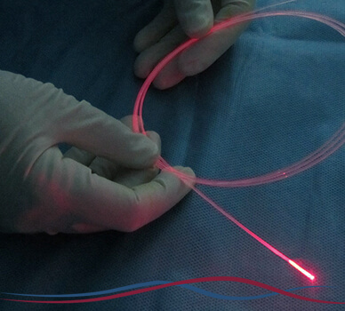 Imagem Cirurgia de Varizes (Laser Endovenoso)