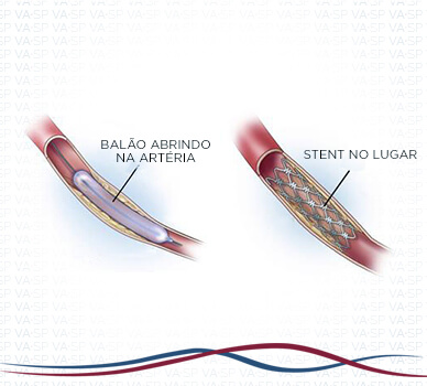 Imagem Angioplastia das Artérias da Perna - Stent